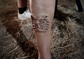 Prosthetic s