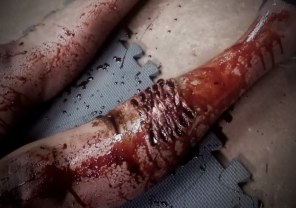Prosthetic s