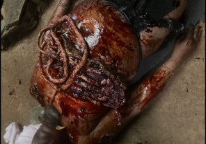 Prosthetic s